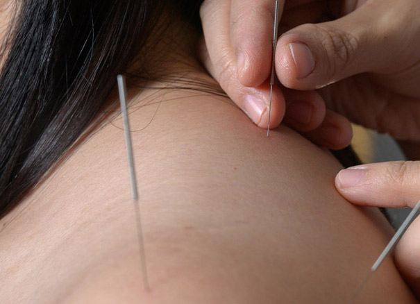 acupuncture sage femme
